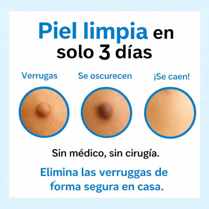 Eliminador de verrugas