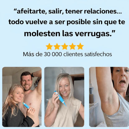 Eliminador de verrugas